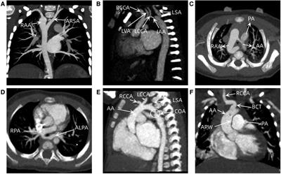 Accuracy and image quality of wide-detector revolution CT angiography combined with prospective ECG-triggered CT angiography in the diagnosis of congenital aortic arch anomalies in Chinese children